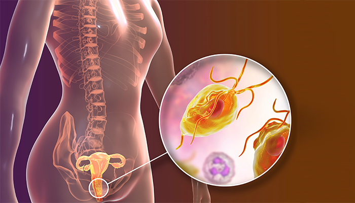 ¿Podemos prevenir la cervicitis?